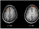 研究发现皮质下脑容量与精神分裂症遗传风险之间没有联系